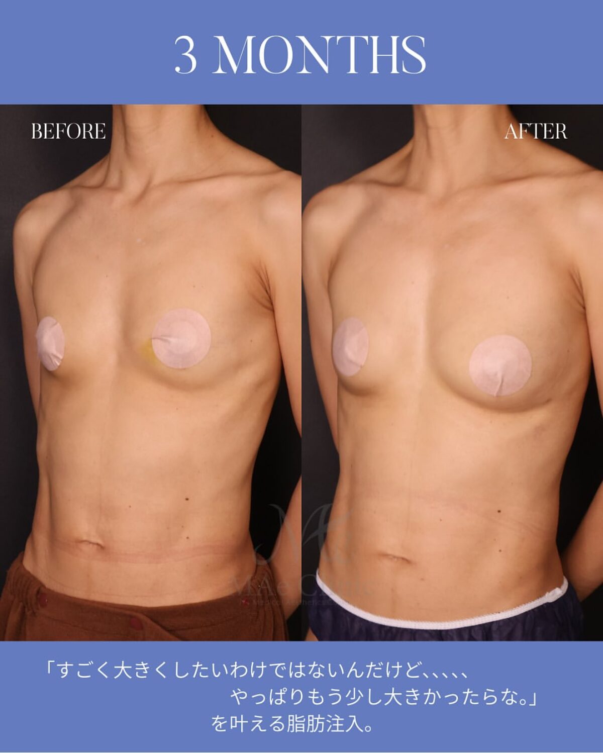 美しい胸は“量”ではなく“デザイン”で決まる｜痩せ型でも可能な脂肪注入