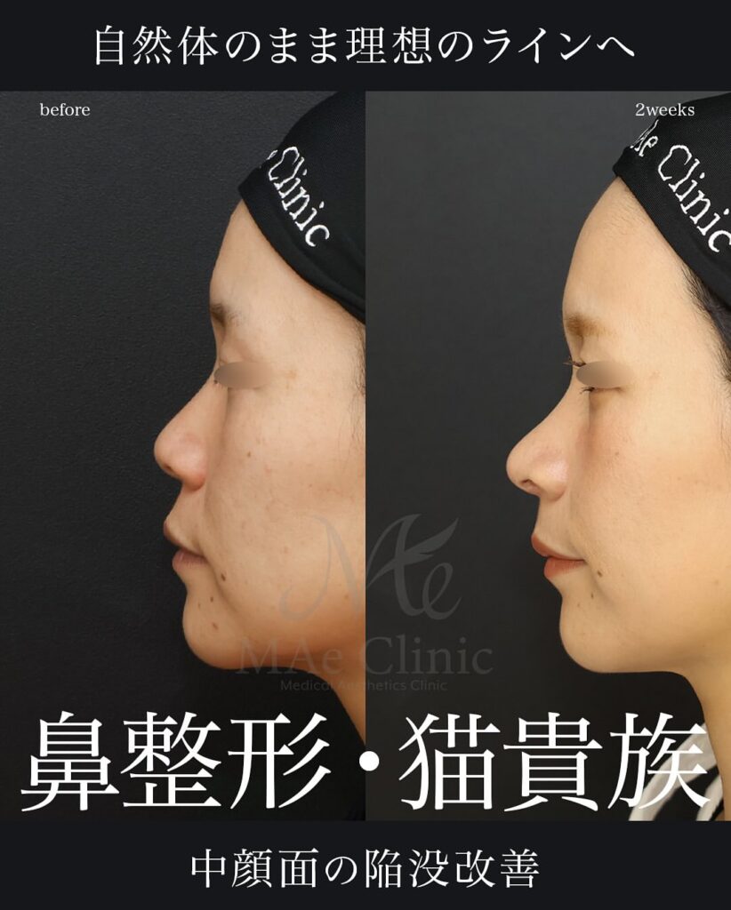 鼻中隔延長(肋軟骨) 鼻尖形成 鼻尖軟骨移植 猫手術(肋軟骨) 症例