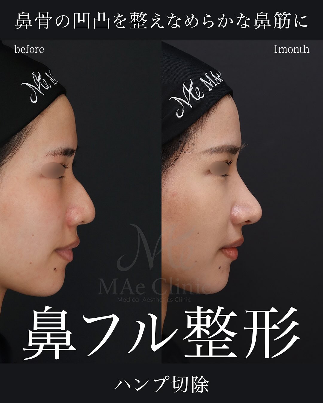 鼻中隔延長とハンプ切除で自然に鼻筋を整えた症例｜望月正人医師 | MAe Clinic【マエクリ】