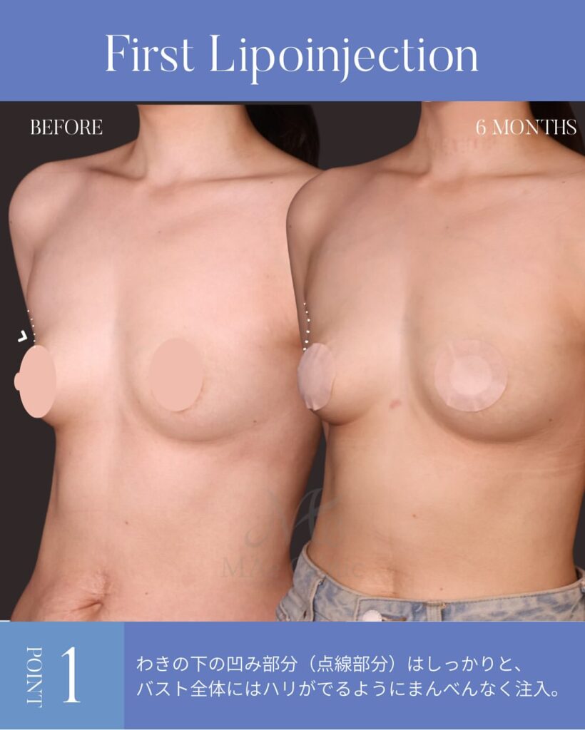 授乳後にしぼんだ胸を改善した脂肪豊胸のビフォーアフター症例(木下恵里沙医師)