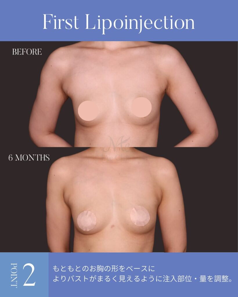 授乳後にしぼんだ胸を改善した脂肪豊胸のビフォーアフター症例(木下恵里沙医師)