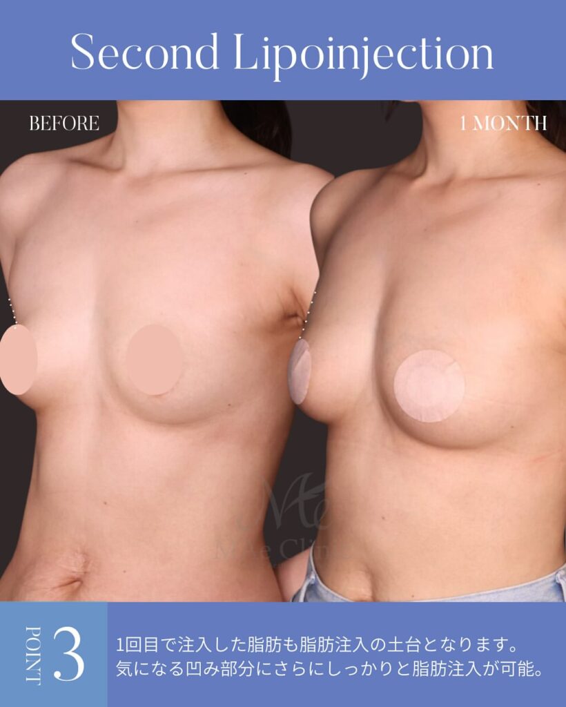 授乳後にしぼんだ胸を改善した脂肪豊胸のビフォーアフター症例(木下恵里沙医師)