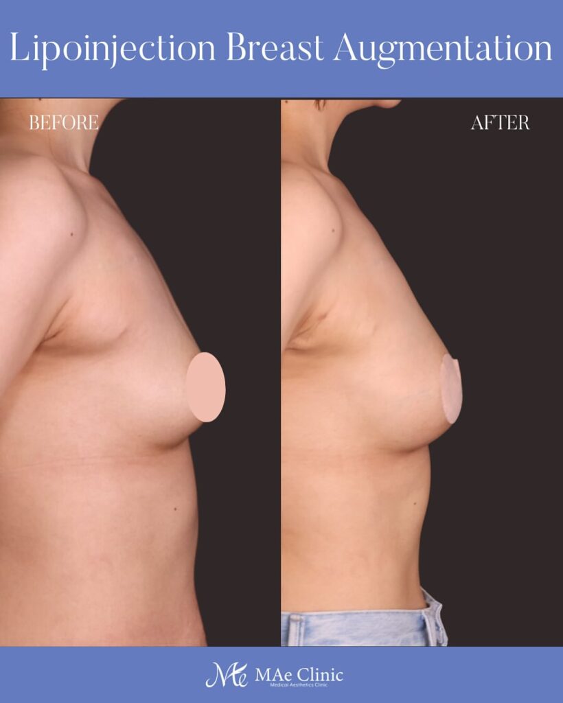 授乳後にしぼんだ胸を改善した脂肪豊胸のビフォーアフター症例(木下恵里沙医師)