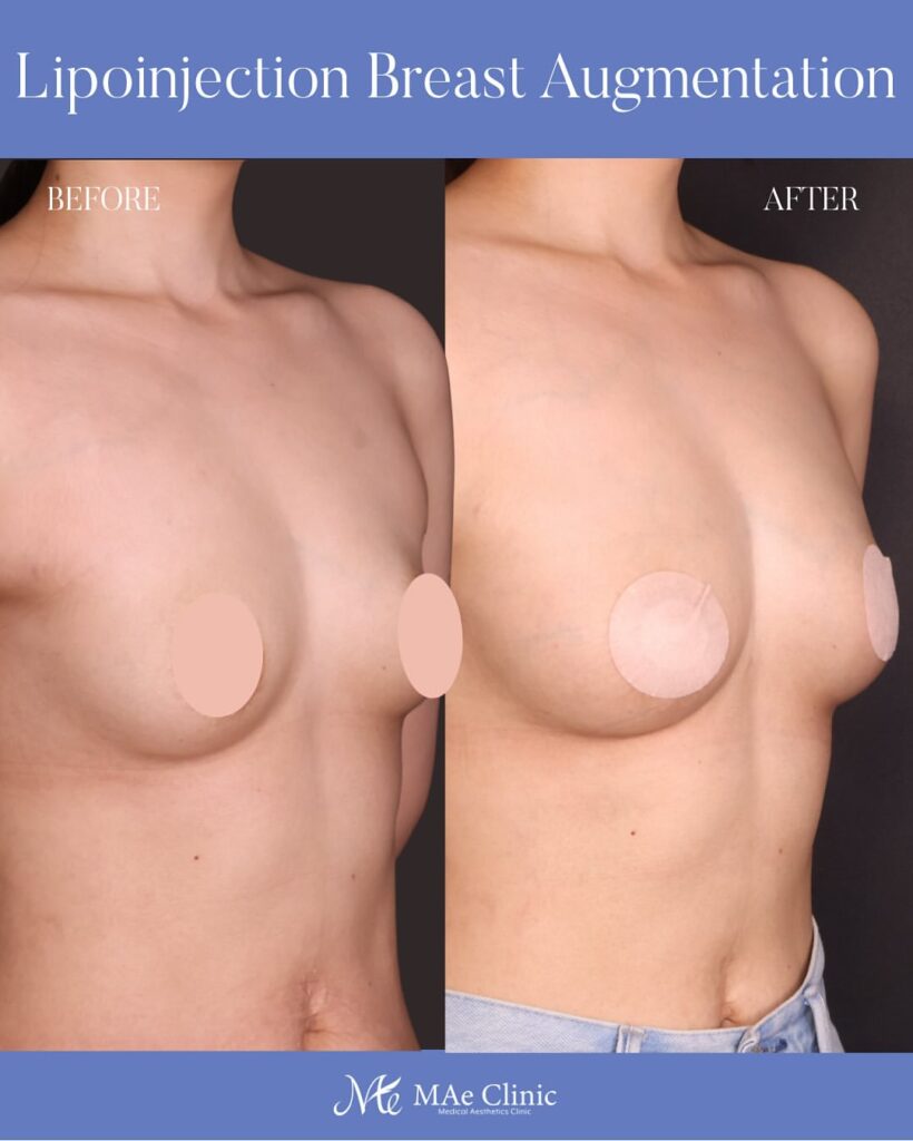 授乳後にしぼんだ胸を改善した脂肪豊胸のビフォーアフター症例(木下恵里沙医師)