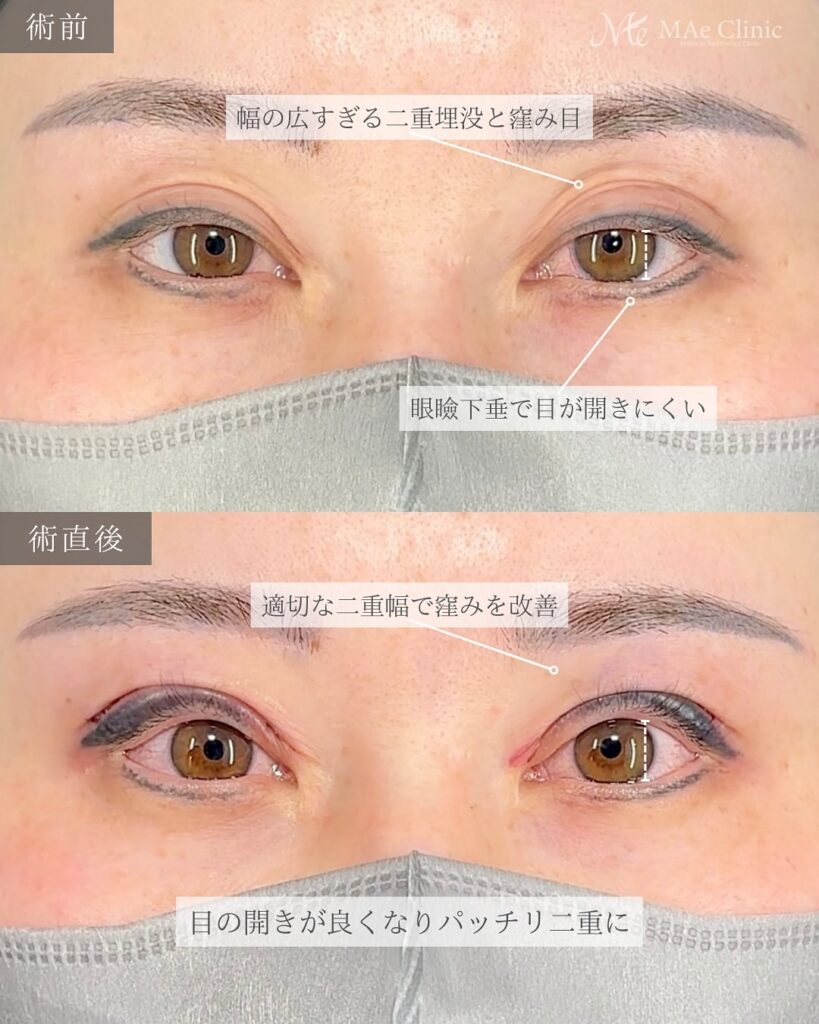 眼瞼下垂手術（二重全切開＋挙筋前転術）で眠たそうな印象を改善し、パッチリ二重になった症例の術後写真