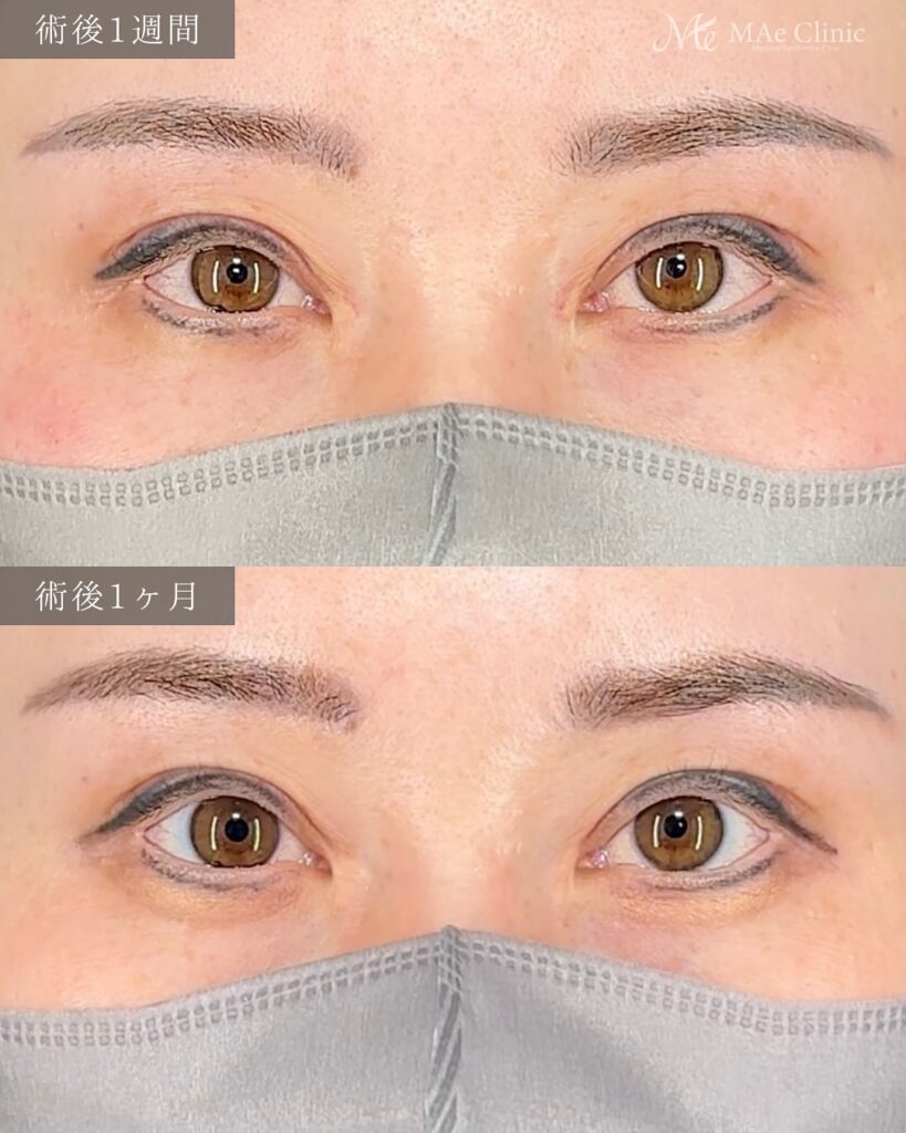 眼瞼下垂手術（二重全切開＋挙筋前転術）で眠たそうな印象を改善し、パッチリ二重になった症例の術後写真