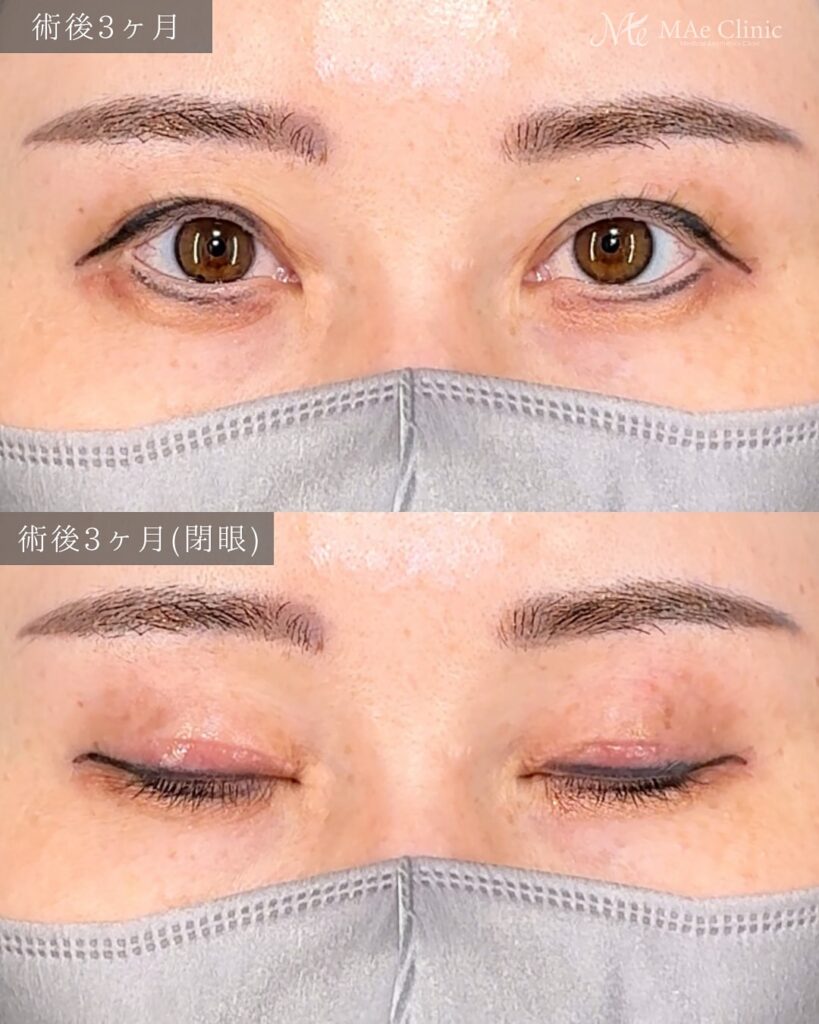 眼瞼下垂手術（二重全切開＋挙筋前転術）で眠たそうな印象を改善し、パッチリ二重になった症例の術後写真