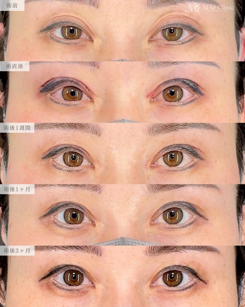眼瞼下垂手術（二重全切開＋挙筋前転術）で眠たそうな印象を改善し、パッチリ二重になった症例の術後写真