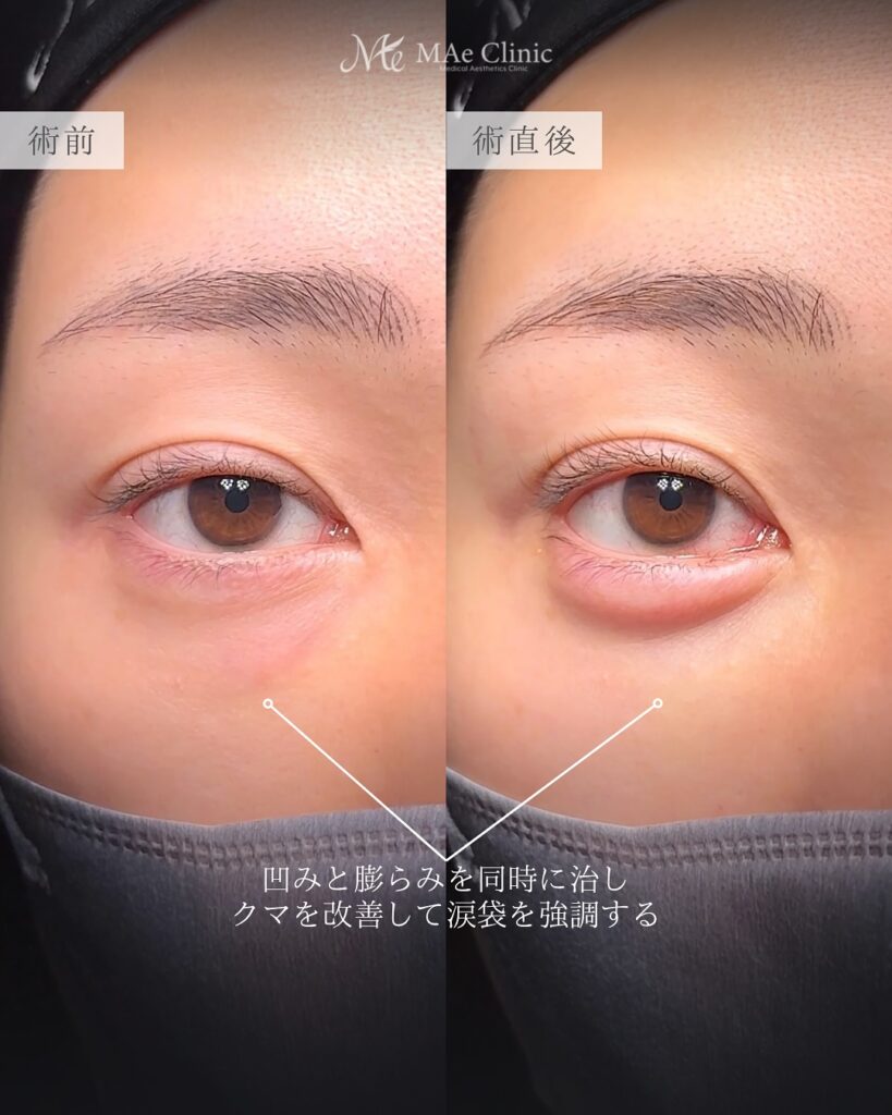 裏ハムラ法によるクマ取りで目の下の膨らみと凹みを改善し、涙袋が自然に出てきた症例(術後写真):前之園健太医師の症例