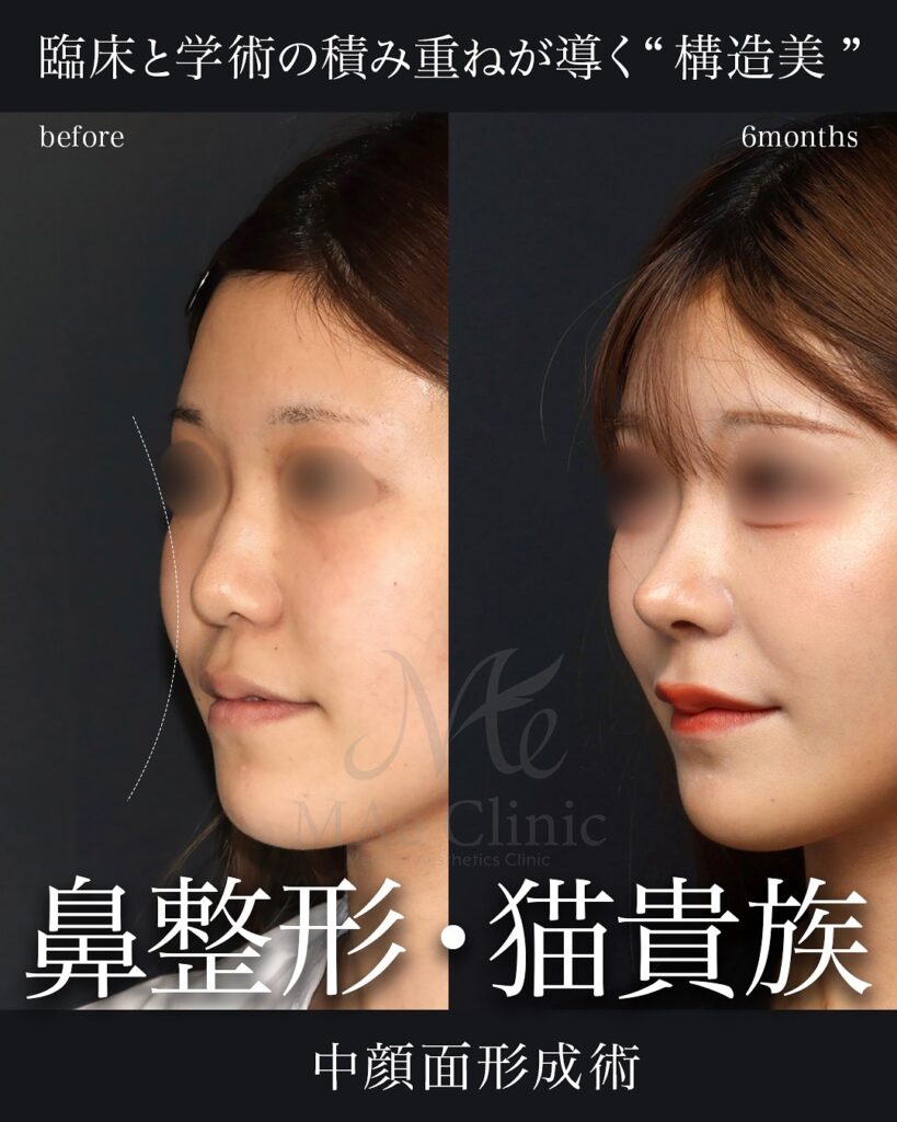 鼻形成と肋軟骨移植により中顔面の凹みと鼻のバランスを整え、可愛らしさと大人っぽさを両立した症例(術後写真)前田翔医師