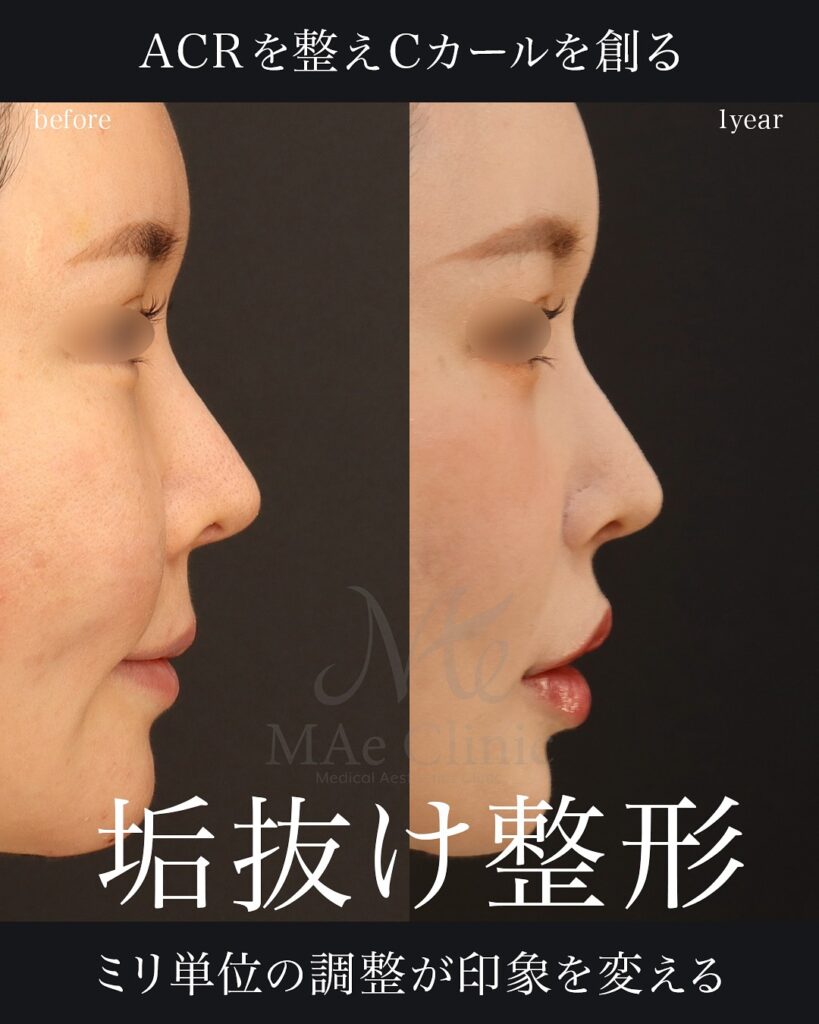 鼻翼縮小・鼻翼挙上・裏人中短縮を組み合わせて、鼻翼の自然な丸みを保ちつつ立体的な口元に改善した症例(術後1年)前田翔医師