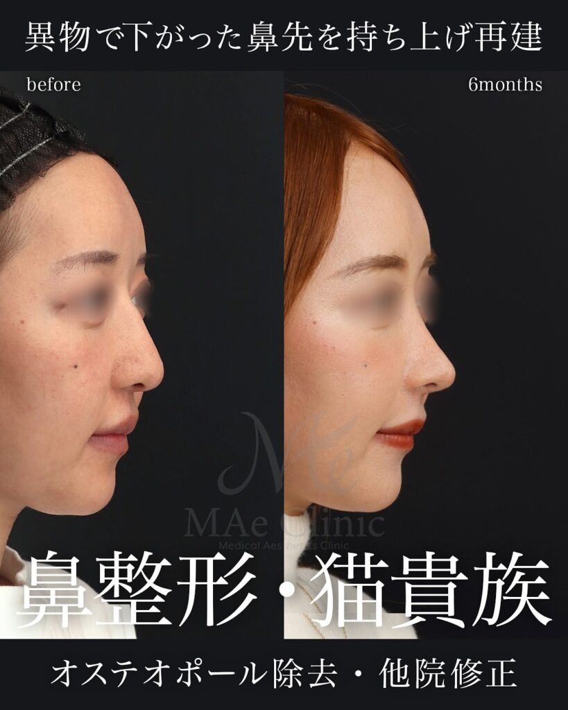 鼻骨骨切りと肋軟骨移植でわし鼻を改善し、鼻先と中顔面のバランスを整えた症例(術後6ヶ月)前田翔医師