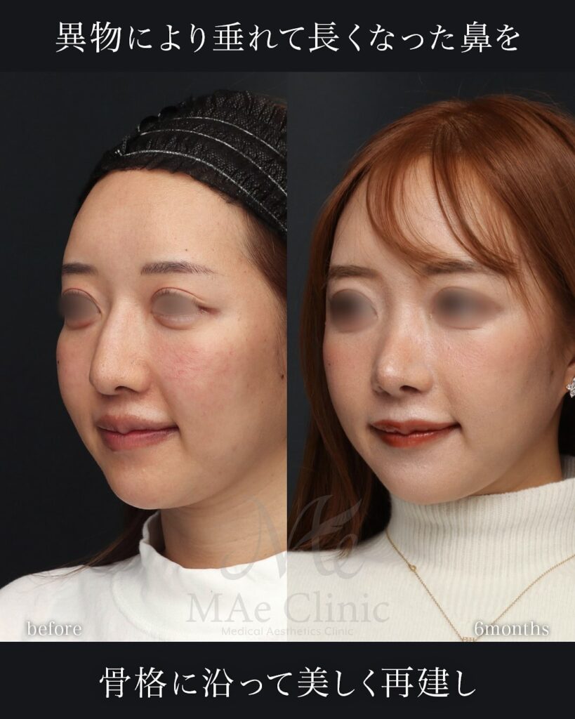 鼻骨骨切りと肋軟骨移植でわし鼻を改善し、鼻先と中顔面のバランスを整えた症例(術後6ヶ月)前田翔医師
