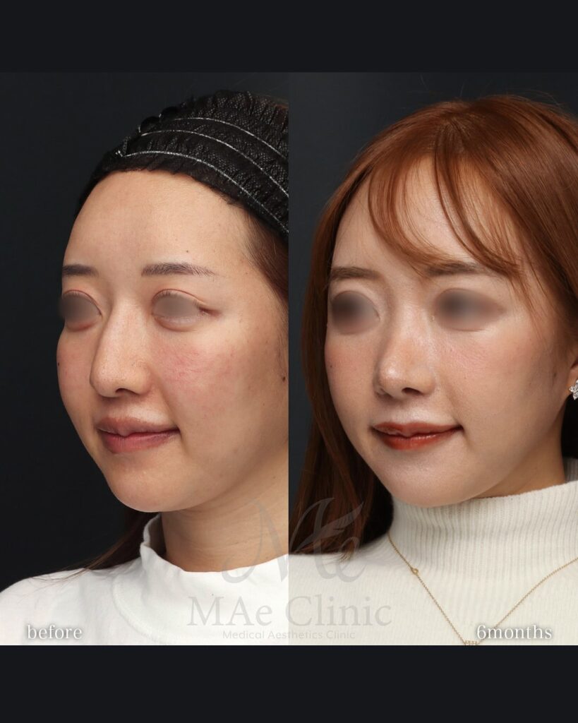 鼻骨骨切りと肋軟骨移植でわし鼻を改善し、鼻先と中顔面のバランスを整えた症例(術後6ヶ月)前田翔医師