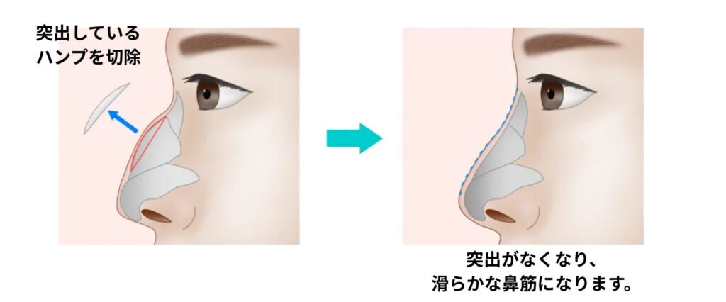 ハンプ切除