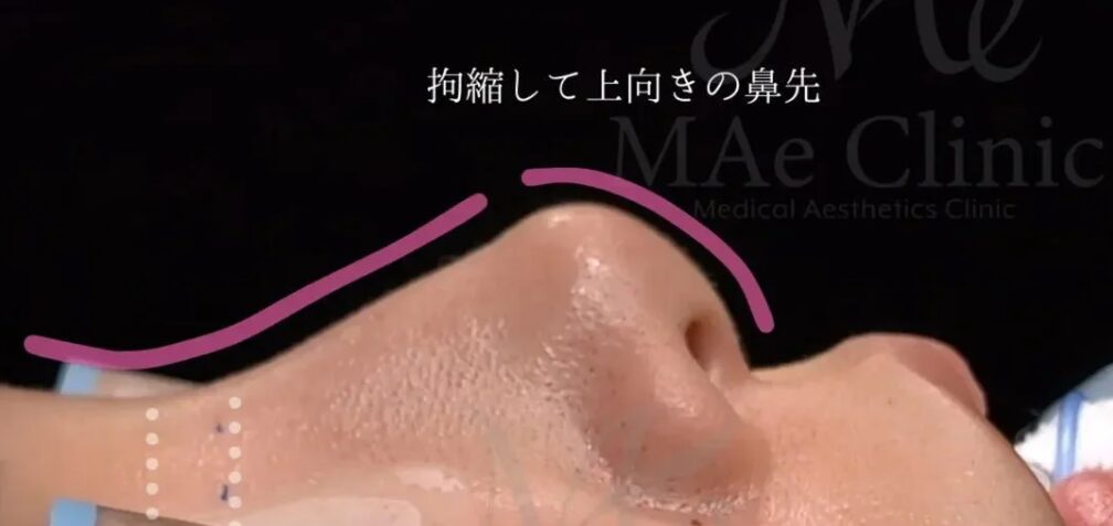 拘縮して上向きの鼻