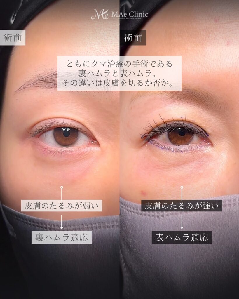裏ハムラと表ハムラの違い　前之園健太医師症例