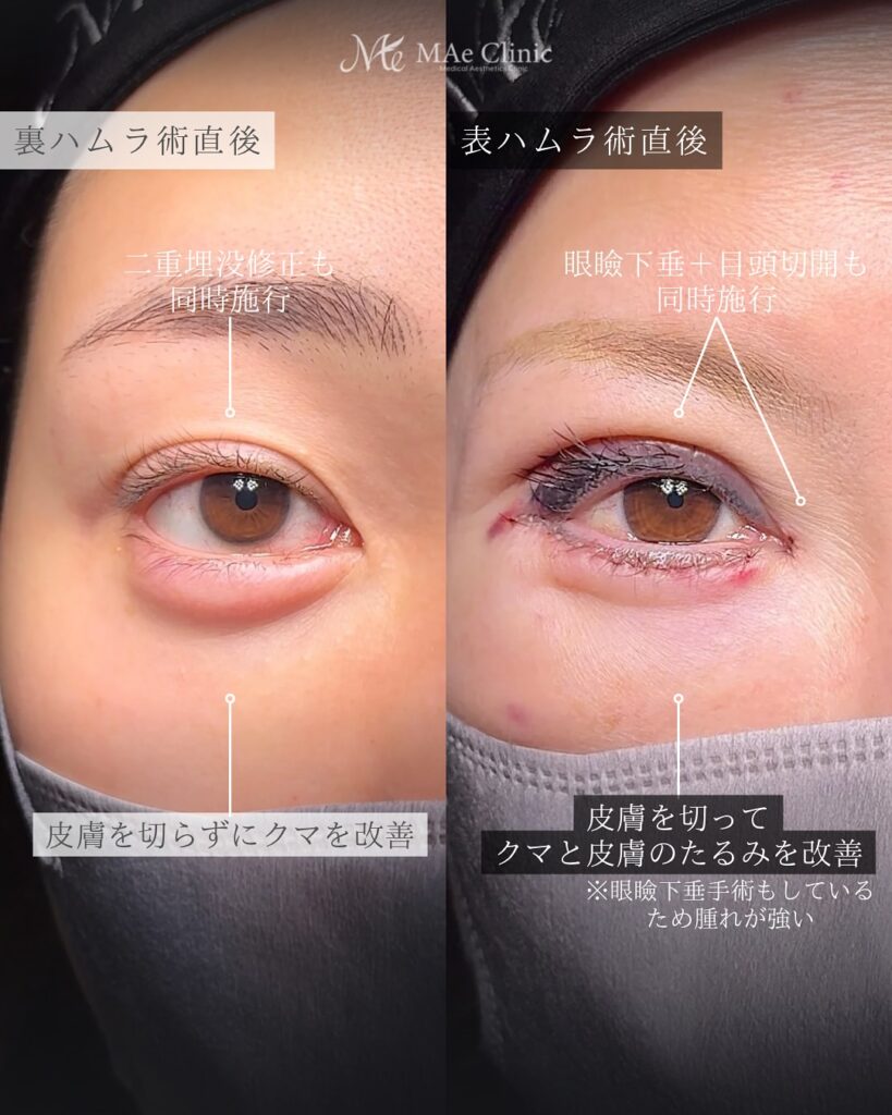 裏ハムラと表ハムラの違い　前之園健太医師症例