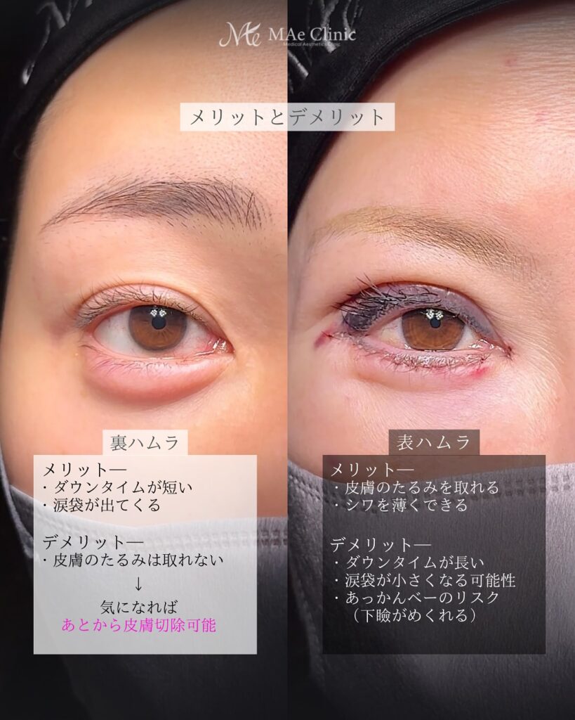 裏ハムラと表ハムラの違い　前之園健太医師症例