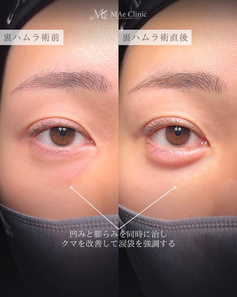 裏ハムラと表ハムラの違い　前之園健太医師症例