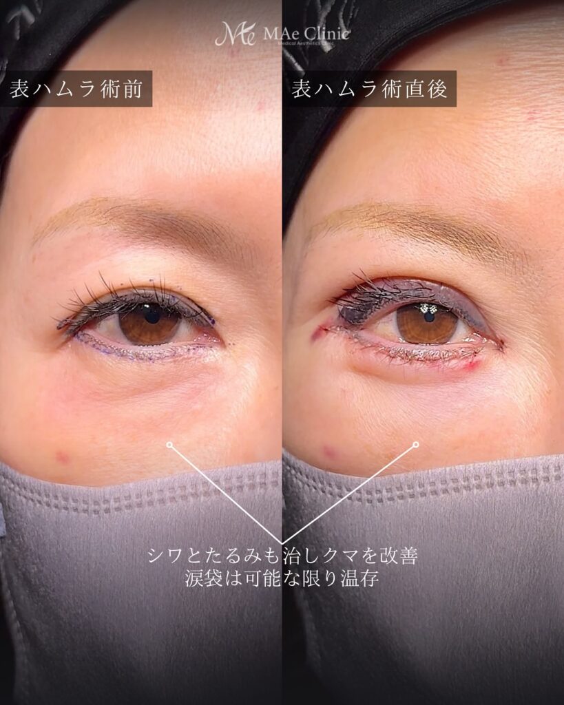 裏ハムラと表ハムラの違い　前之園健太医師症例