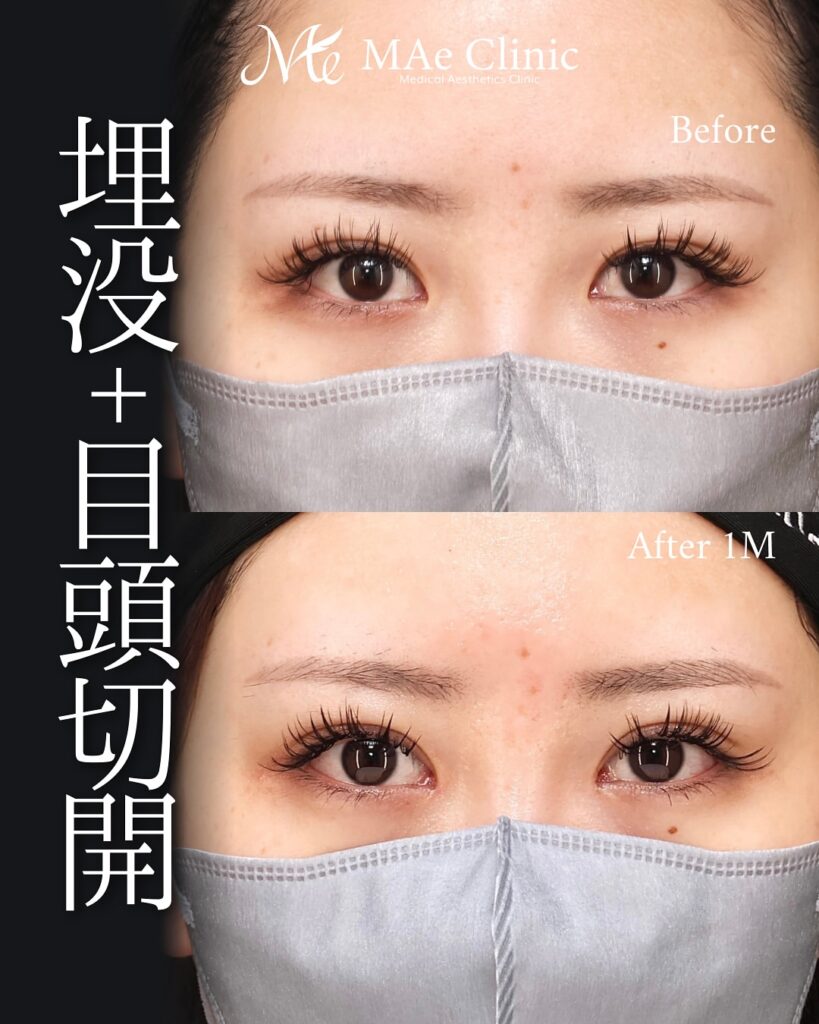 埋没　目頭切開症例
前之園医師