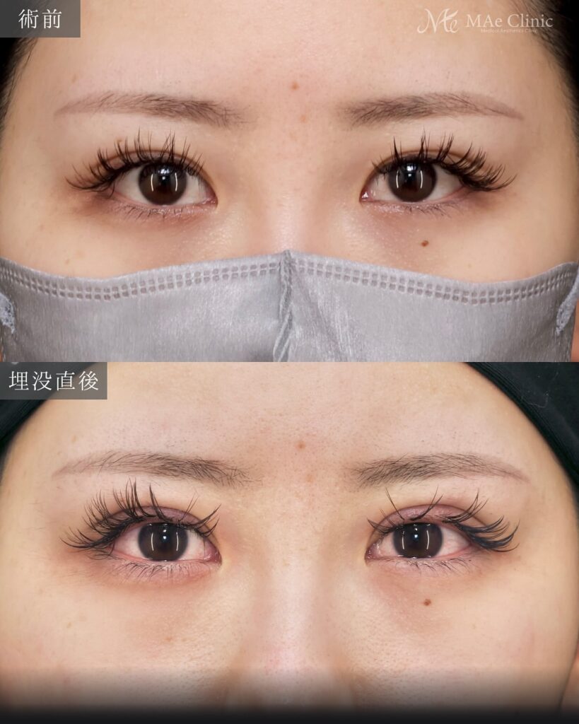 埋没　目頭切開症例 前之園医師
