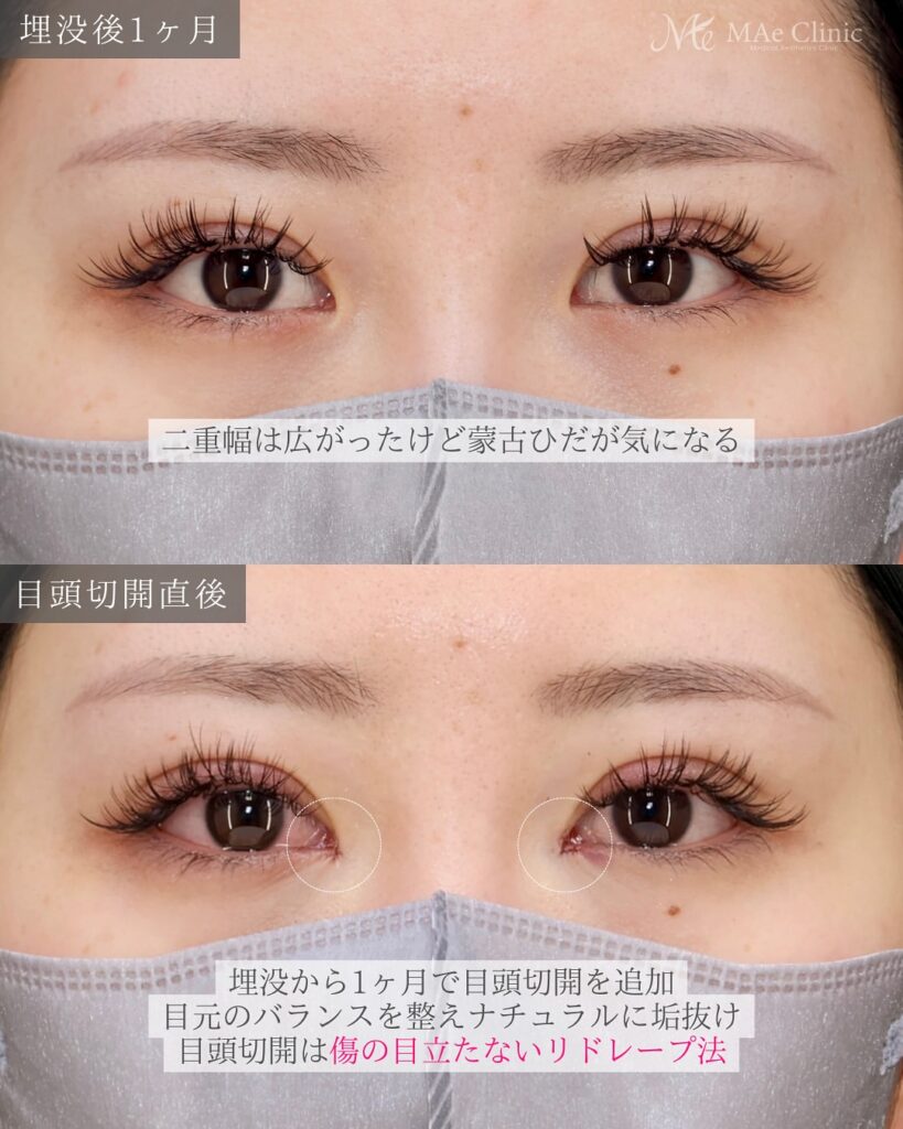 埋没　目頭切開症例 前之園医師
