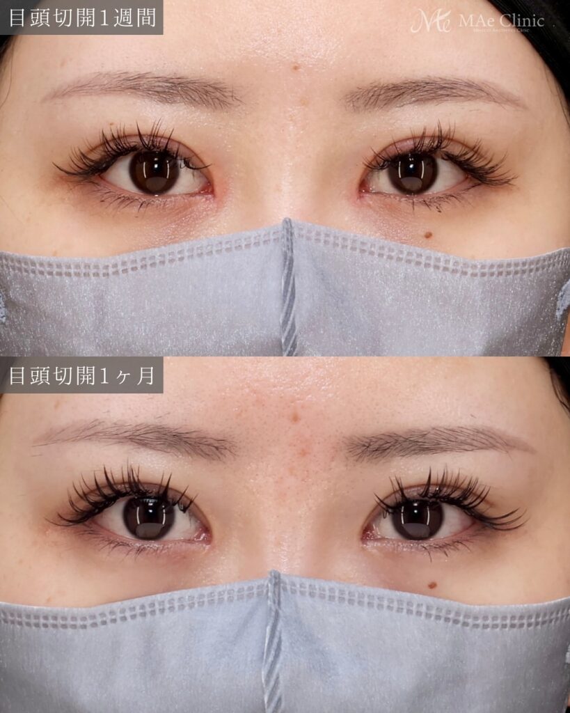 埋没　目頭切開症例 前之園医師