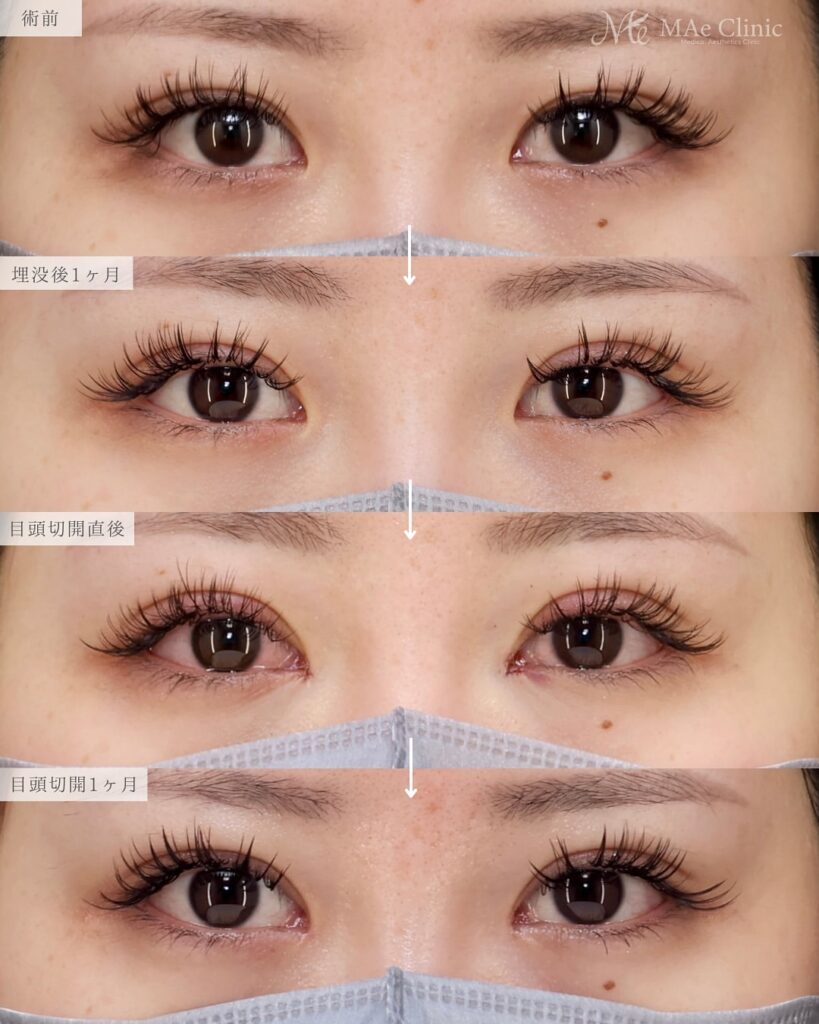 埋没　目頭切開症例 前之園医師