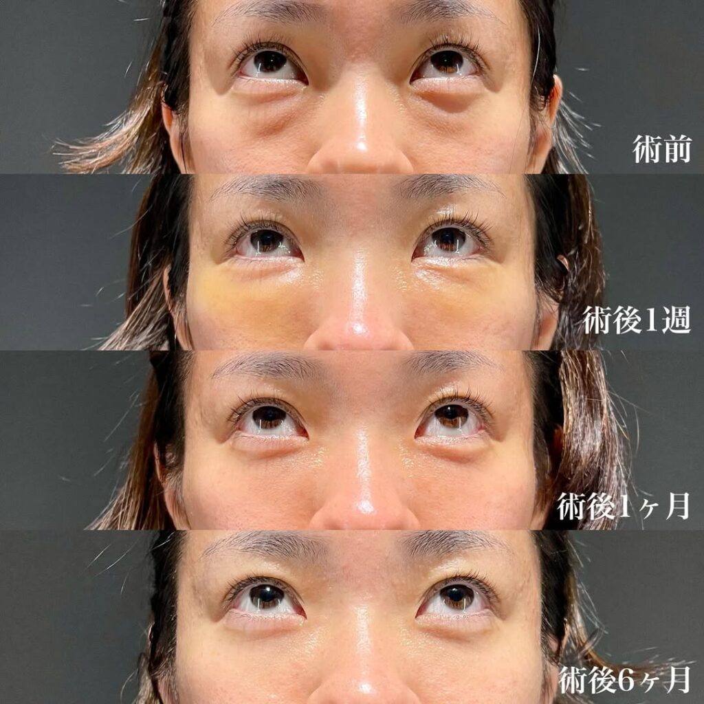 裏ハムラ症例