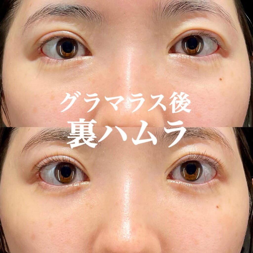 裏ハムラ症例