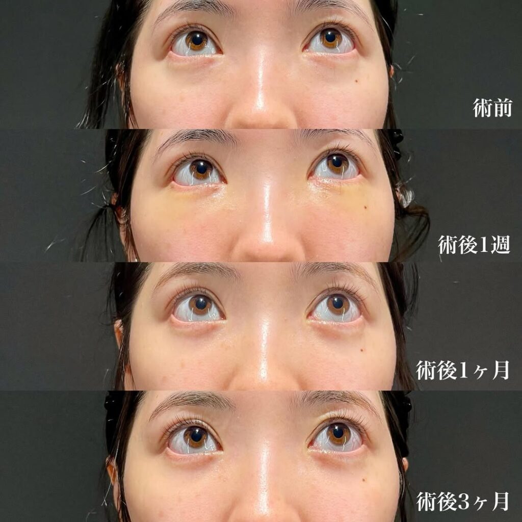 裏ハムラ症例
