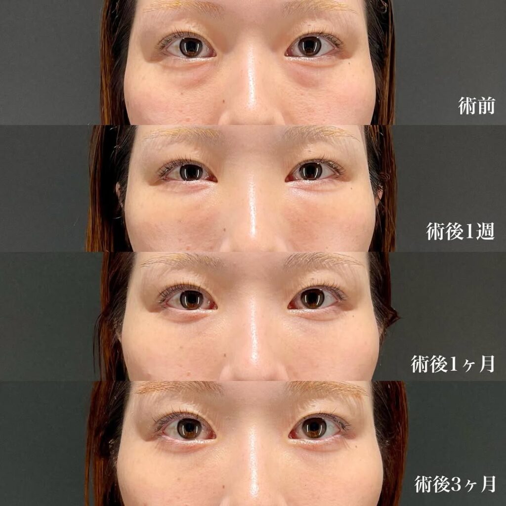 裏ハムラ症例