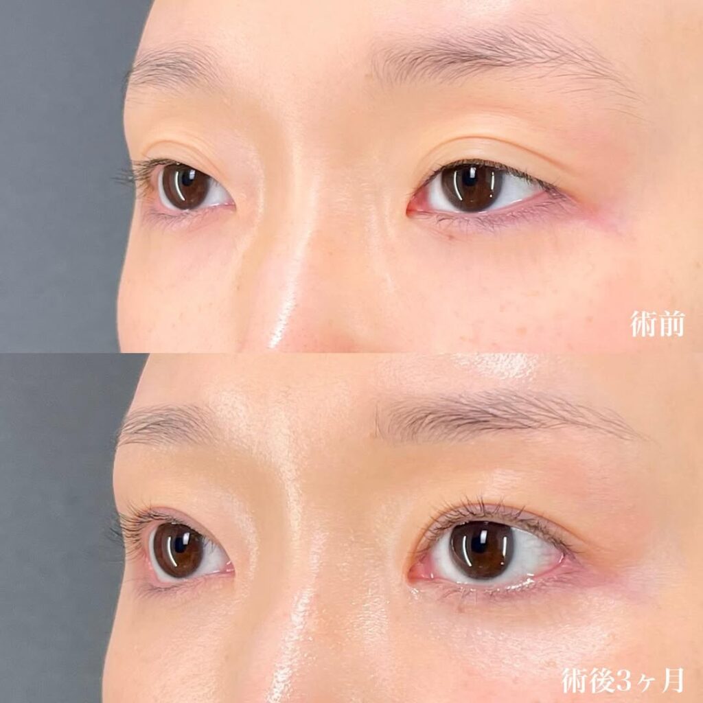 目フル症例