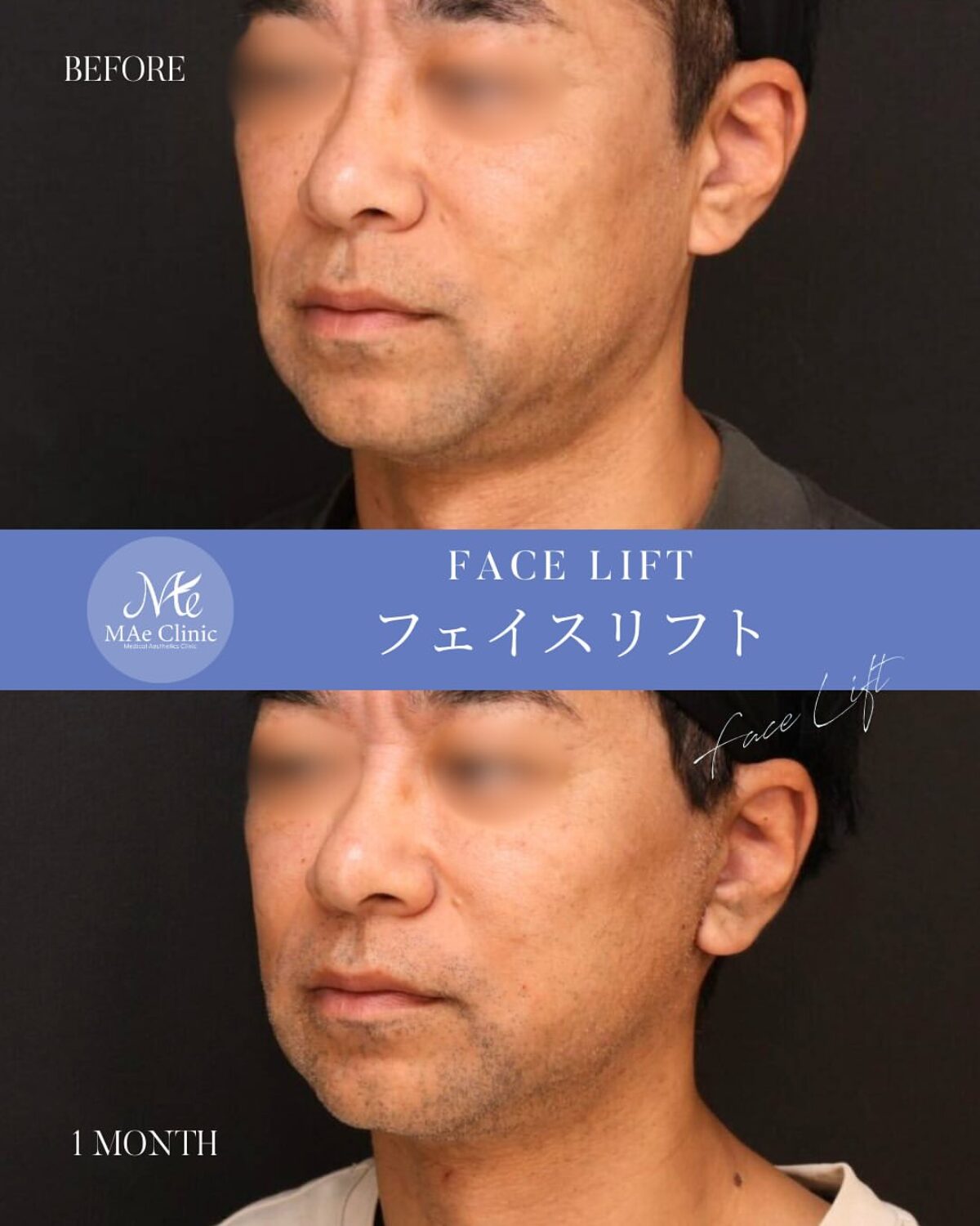症例】切開リフトでフェイスラインを改善｜40代男性が-10歳若返った