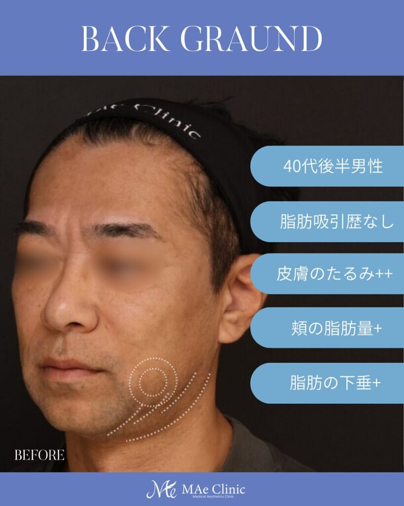 【切開リフト(フェイスリフト)】 木下恵里沙医師症例