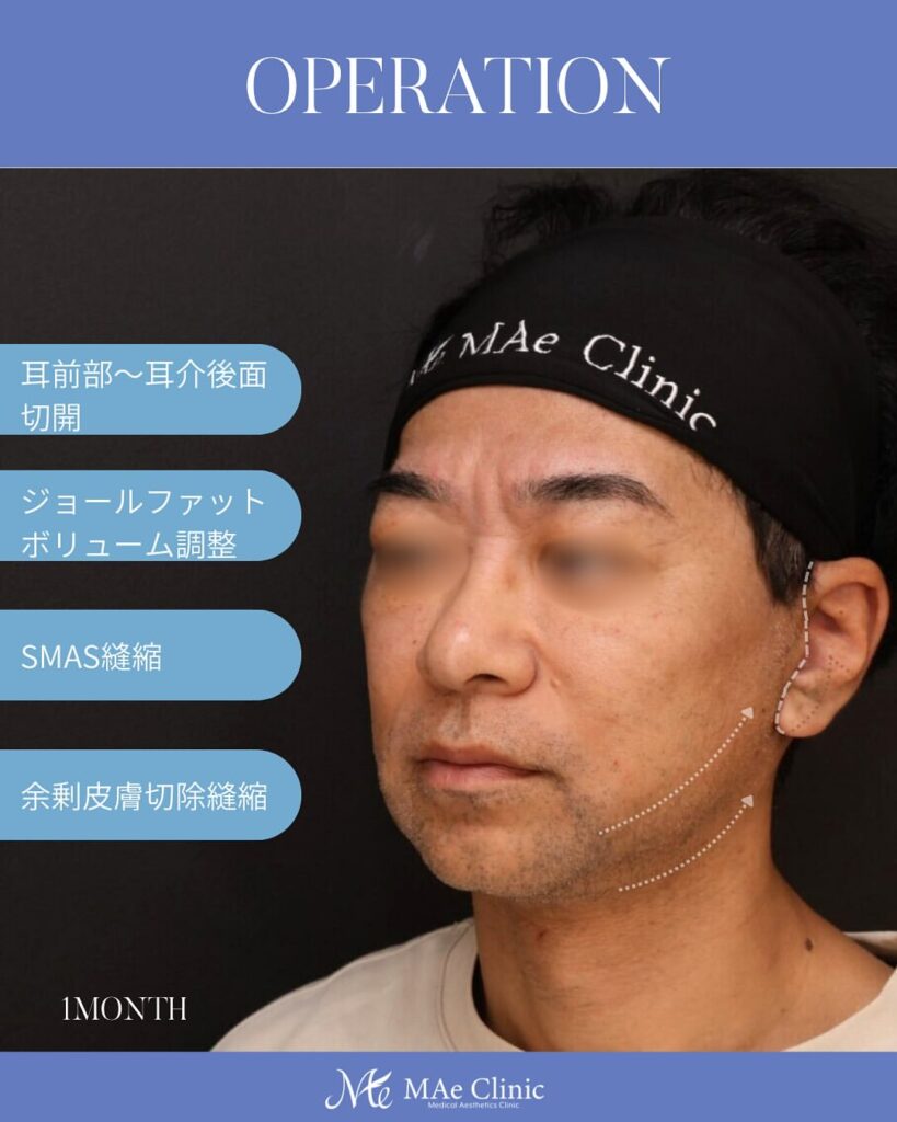 【切開リフト(フェイスリフト)】 木下恵里沙医師症例