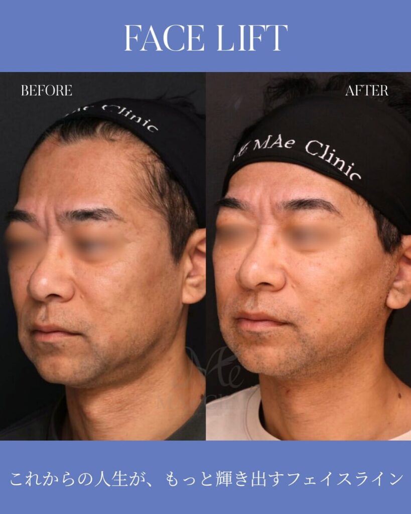 【切開リフト(フェイスリフト)】 木下恵里沙医師症例