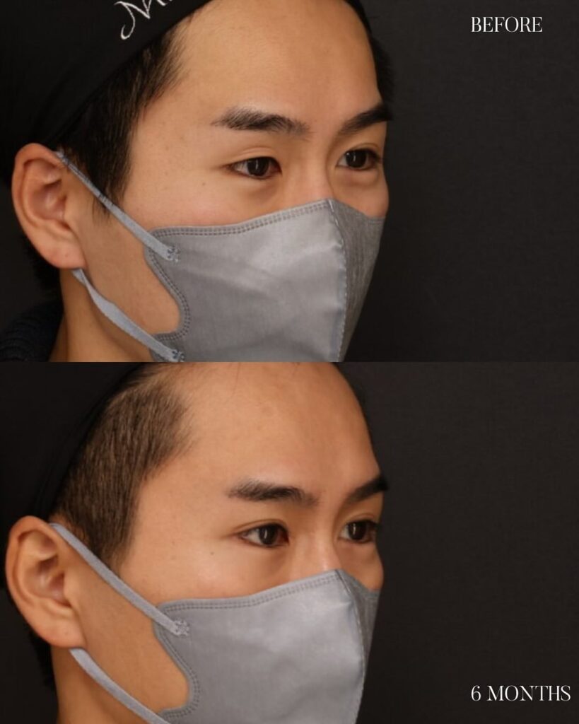 埋没式重瞼術　自然癒着法　木下恵里沙医師症例