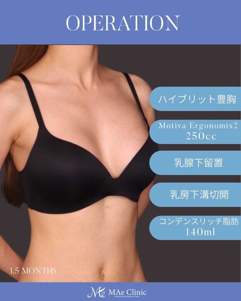 ハイブリッド豊胸症例　木下恵里沙医師