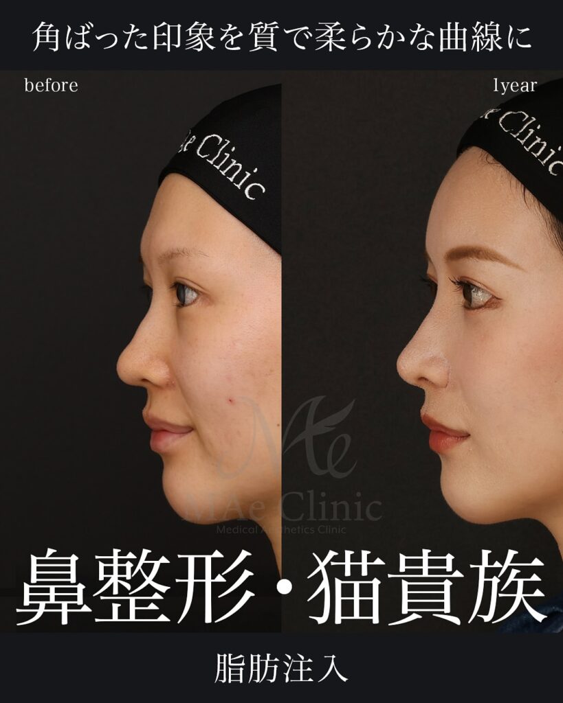 鼻中隔延長（肋軟骨）
鼻尖形成
鼻尖軟骨移植
鼻骨骨切り
隆鼻(肋軟骨)
鼻翼縮小(内)
猫貴族手術（肋軟骨)
脂肪注入(額＋目の下＋頬)
口角挙上
白目拡大術(他院修正)

前田翔医師症例