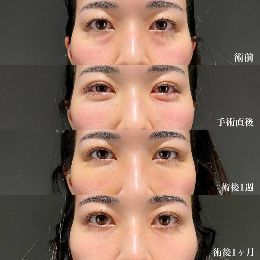 埋没二重　裏ハムラ　症例