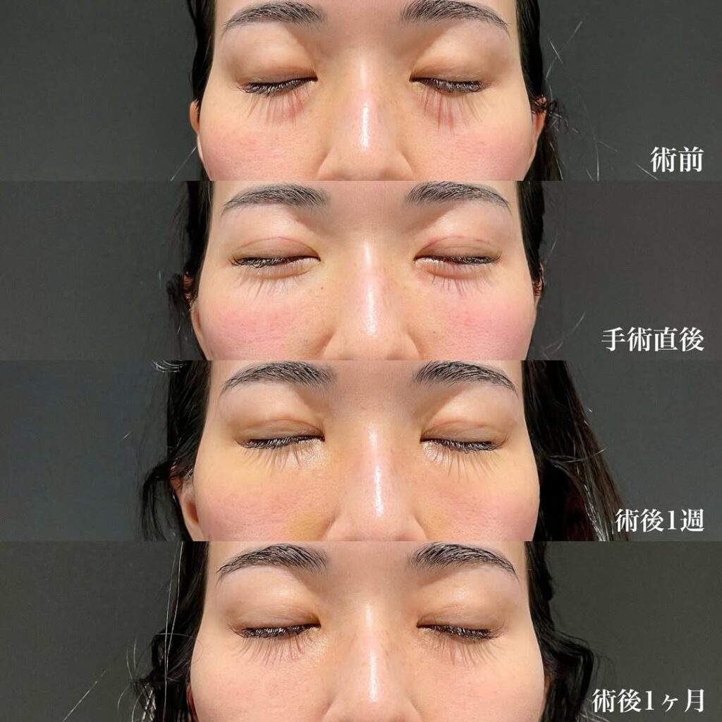 埋没二重　裏ハムラ　症例