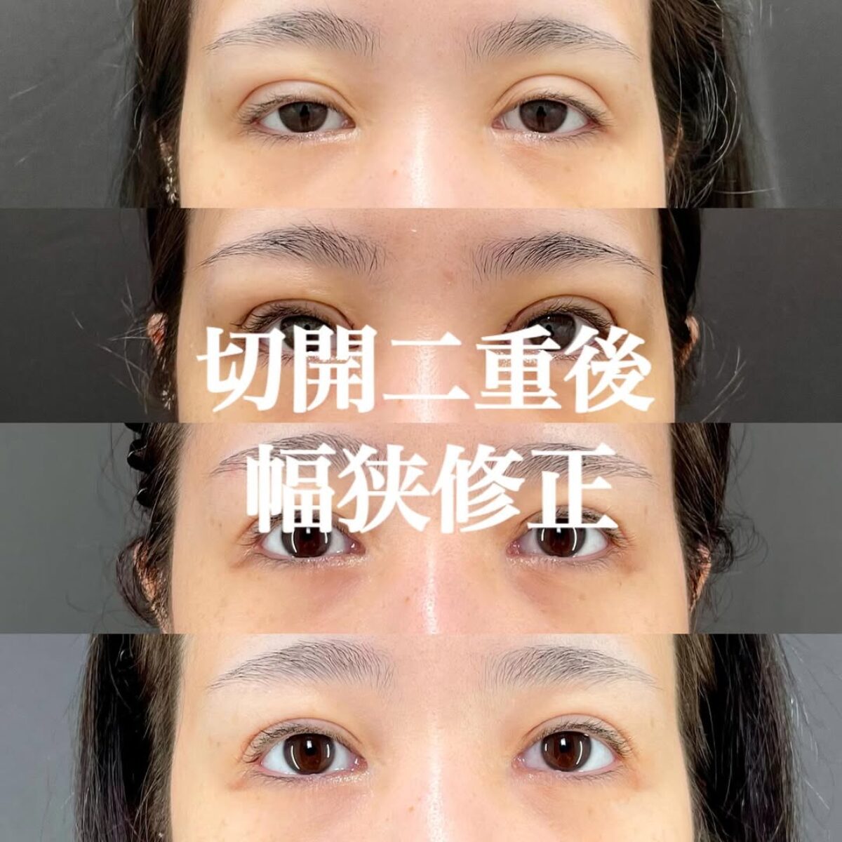 眼手術学 2 眼瞼 m3電子書籍 | 眼手術学 2 眼瞼