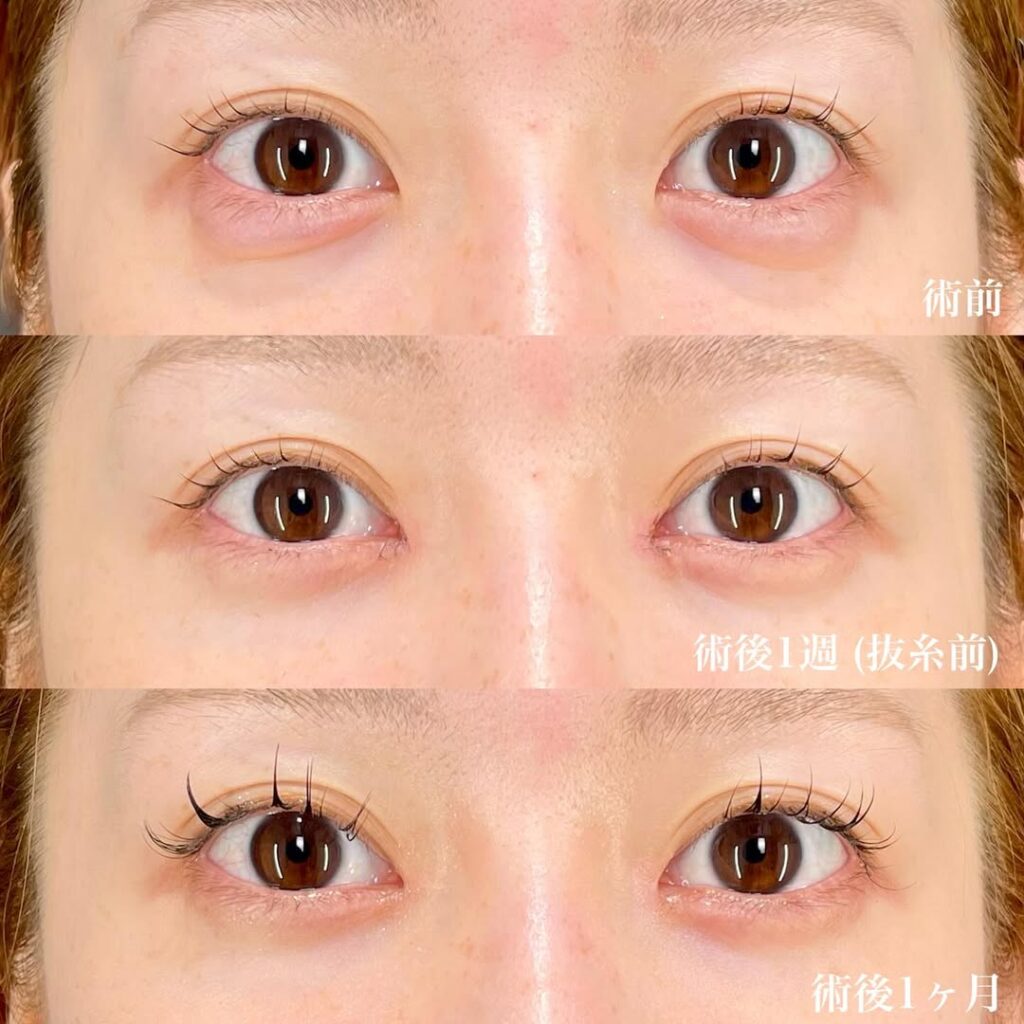 目頭切開症例