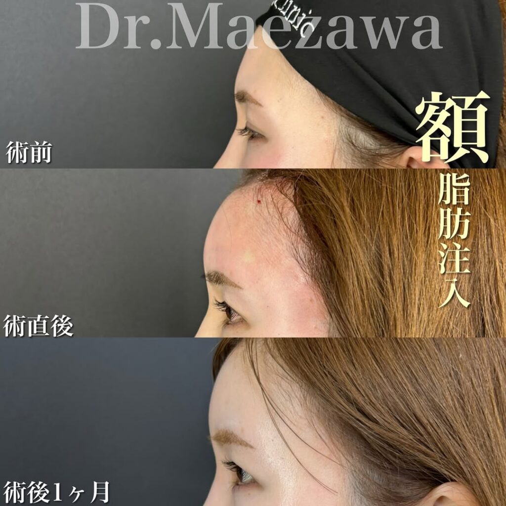 鼻尖形成+耳介軟骨による鼻中隔延長（自家軟骨移植）+鼻柱下降+額脂肪注入+頬下・ジョールファット吸引+糸リフト（アルテミスリフト、fiora thread）の顔フル 症例