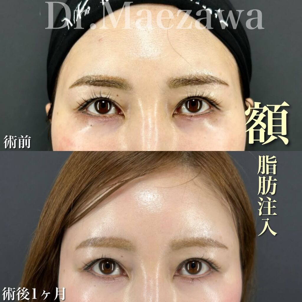 鼻尖形成+耳介軟骨による鼻中隔延長（自家軟骨移植）+鼻柱下降+額脂肪注入+頬下・ジョールファット吸引+糸リフト（アルテミスリフト、fiora thread）の顔フル 症例