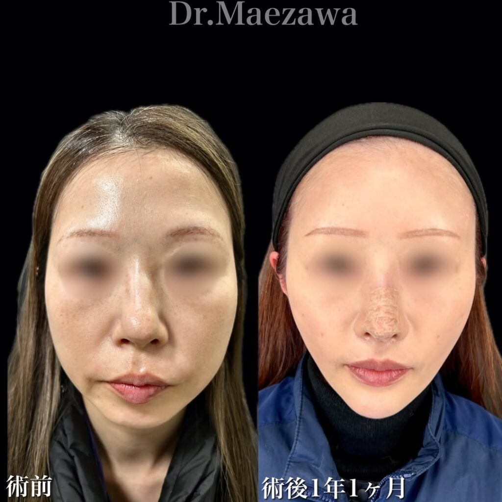 フル切開フェイスリフト(extended deep plane)+頬・顎下脂肪吸引+脂肪注入(額、こめかみ、ゴルゴライン)+鼻中隔延長(肋軟骨移植)オトガイ形成、表ハムラ、ミッドフェイスリフト、+たるみ取り併用全切開+眼瞼下垂(挙筋前転、外角処理)+目尻切開・目尻靭帯移動、グラマラスライン形成の顔フルモニター 症例
