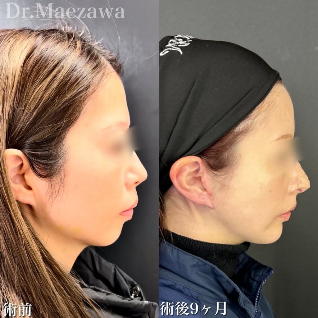 フル切開フェイスリフト(extended deep plane)+頬・顎下脂肪吸引+脂肪注入(額、こめかみ、ゴルゴライン)+鼻中隔延長(肋軟骨移植)オトガイ形成、表ハムラ、ミッドフェイスリフト、+たるみ取り併用全切開+眼瞼下垂(挙筋前転、外角処理)+目尻切開・目尻靭帯移動、グラマラスライン形成の顔フルモニター 症例